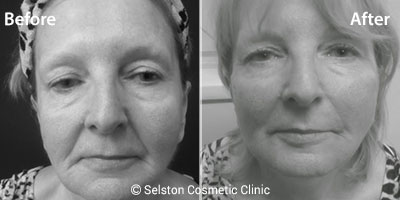 Selston-cosmetic-clinic-face-treatment