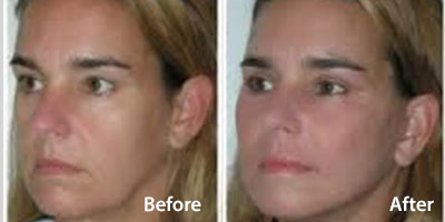 Selston-cosmetic-clinic-face-treatment