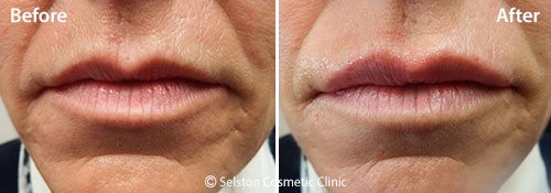 Selston-cosmetic-clinic-dermal-fillers