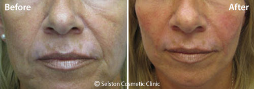 Selston-cosmetic-clinic-dermal-fillers