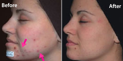 Selston-cosmetic-clinic-acne-laser