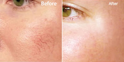 Selston-cosmetic-clinic-dermal-laser