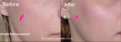 selston cosmetic clinic cheek-enhancement