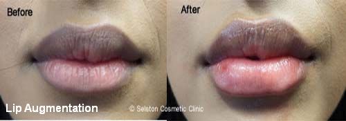 selston cosmetic clinic lip-augmentation